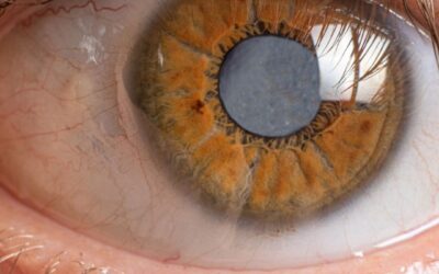 Las Dudas Más Frecuentes Sobre la Operación de Cataratas