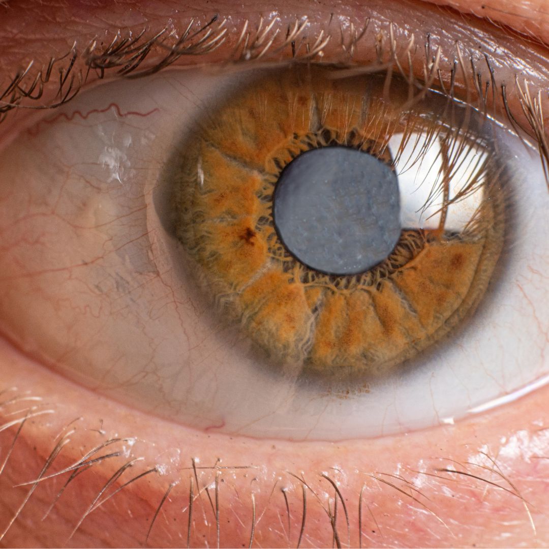 Cuales son las dudas más frecuentes antes de una operación de cataratas