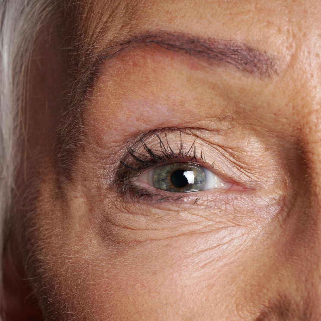 Tiempo de reposo para recuperarse de una cirugía de cataratas